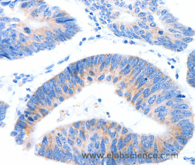 Immunohistochemistry of paraffin-embedded Human colon cancer tissue using MUC3A Polyclonal Antibody at dilution 1:60