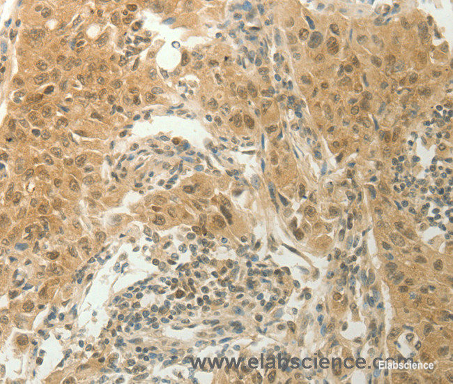Immunohistochemistry of paraffin-embedded Human lung cancer tissue using SLC8A3 Polyclonal Antibody at dilution 1:70