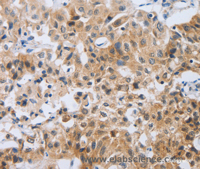 Immunohistochemistry of paraffin-embedded Human lung cancer tissue using NEB Polyclonal Antibody at dilution 1:80