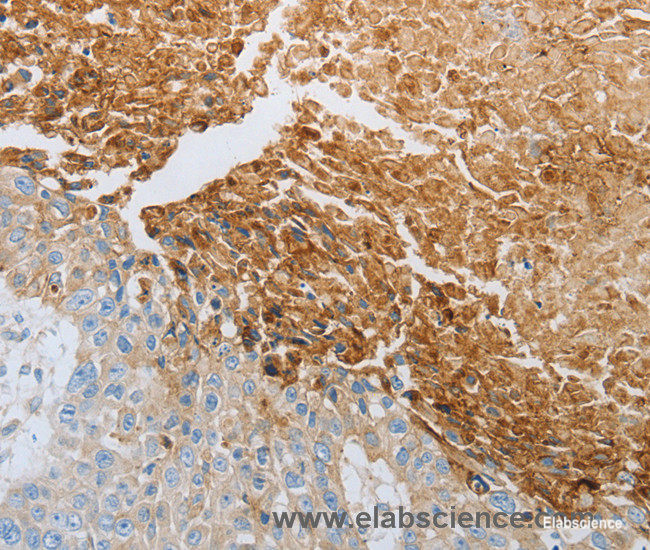 Immunohistochemistry of paraffin-embedded Human esophagus cancer tissue using RTN4 Polyclonal Antibody at dilution 1:40