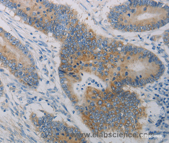 Immunohistochemistry of paraffin-embedded Human colon cancer tissue using CD303 Polyclonal Antibody at dilution of 1:50