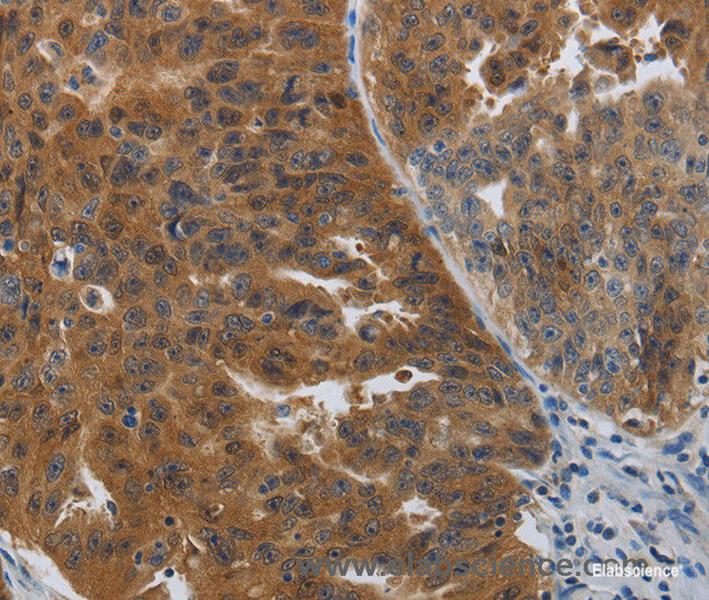 Immunohistochemistry of paraffin-embedded Human ovarian cancer tissue using PDCD2 Polyclonal Antibody at dilution 1:50