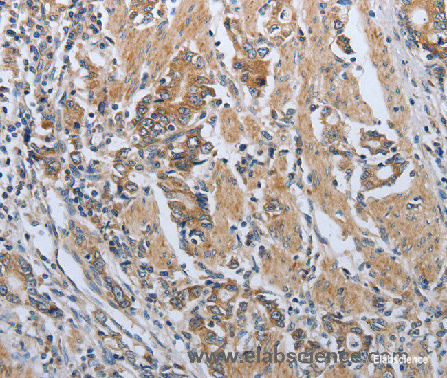Immunohistochemistry of paraffin-embedded Human gasrtic cancer tissue using PD-1/CD279 Polyclonal Antibody at dilution 1:50