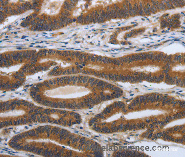 Immunohistochemistry of paraffin-embedded Human colon cancer tissue using PDGFA Polyclonal Antibody at dilution 1:70