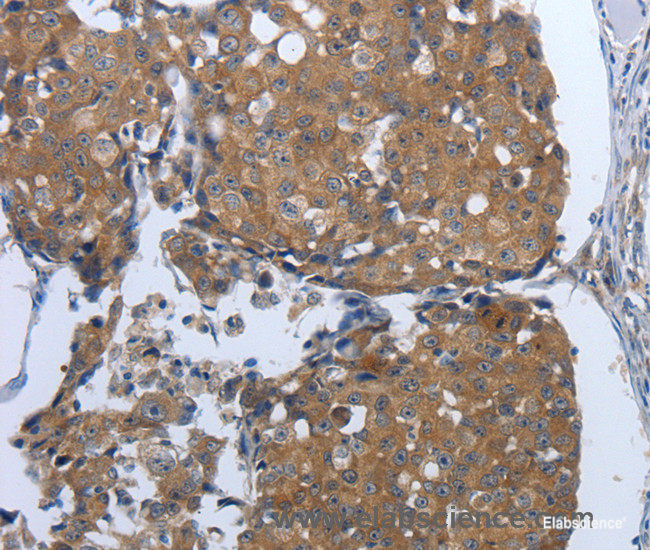 Immunohistochemistry of paraffin-embedded Human breast cancer tissue using PDIA2 Polyclonal Antibody at dilution 1:50