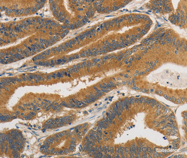 Immunohistochemistry of paraffin-embedded Human colon cancer tissue using PRKD1 Polyclonal Antibody at dilution 1:30