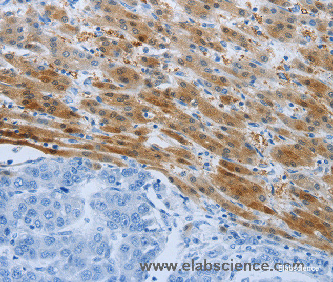 Immunohistochemistry of paraffin-embedded Human liver cancer tissue using PSMD11 Polyclonal Antibody at dilution 1:50
