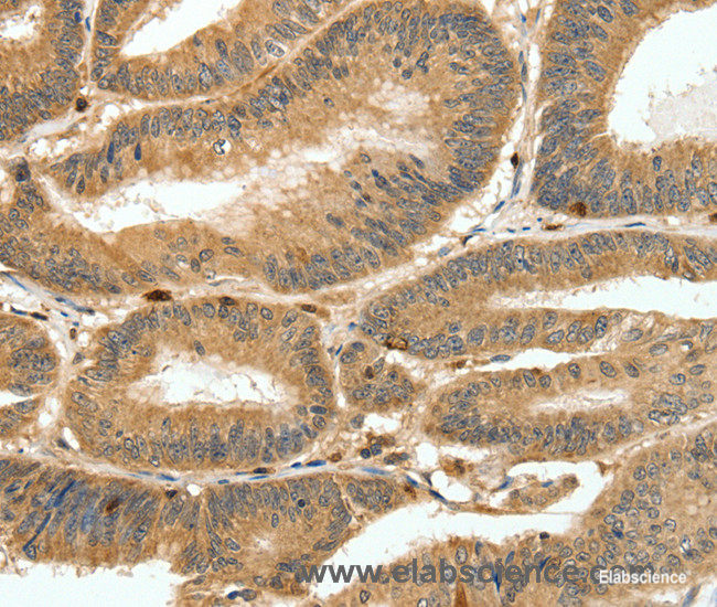 Immunohistochemistry of paraffin-embedded Human colon cancer tissue using S100A4 Polyclonal Antibody at dilution 1:80