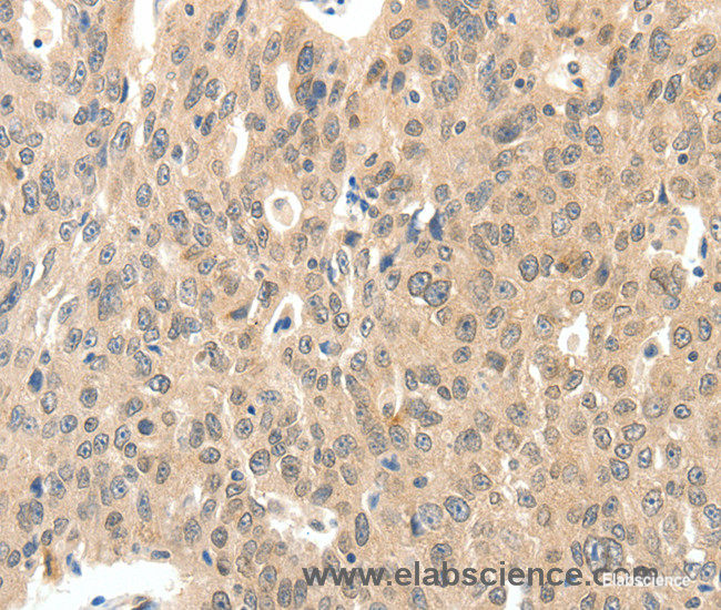 Immunohistochemistry of paraffin-embedded Human ovarian cancer tissue using ROS1 Polyclonal Antibody at dilution 1:40