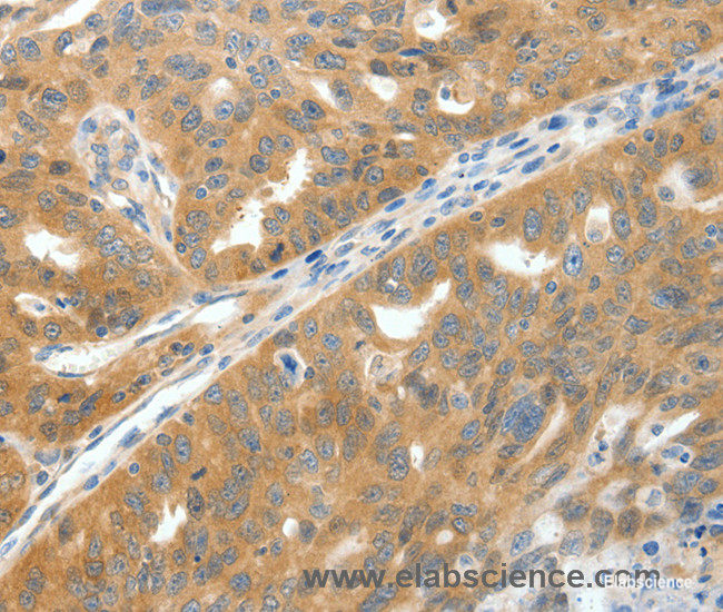 Immunohistochemistry of paraffin-embedded Human ovarian cancer tissue using SCN9A Polyclonal Antibody at dilution 1:40