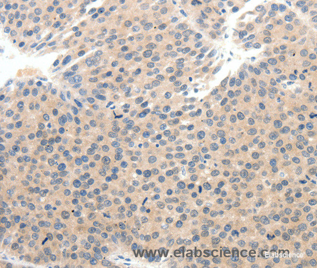 Immunohistochemistry of paraffin-embedded Human breast cancer tissue using SCN10A Polyclonal Antibody at dilution 1:25