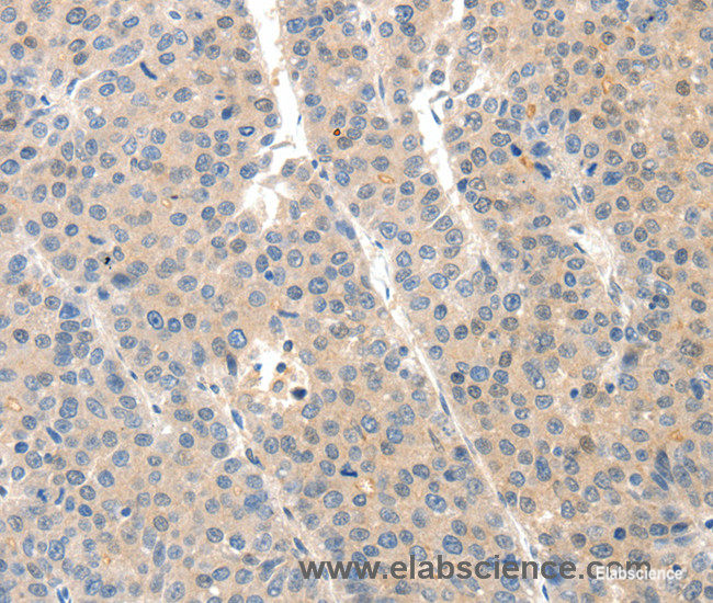 Immunohistochemistry of paraffin-embedded Human liver cancer tissue using SLC20A1 Polyclonal Antibody at dilution 1:40