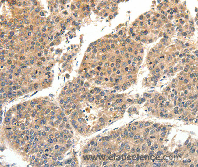 Immunohistochemistry of paraffin-embedded Human liver cancer tissue using SLC27A1 Polyclonal Antibody at dilution 1:40