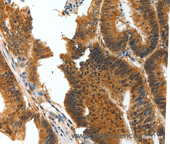 Immunohistochemistry of paraffin-embedded Human colon cancer tissue using BIRC6 Polyclonal Antibody at dilution 1:30