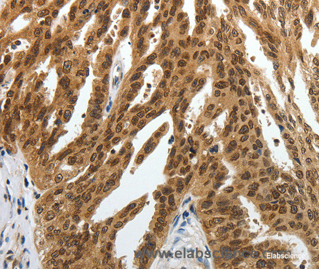 Immunohistochemistry of paraffin-embedded Human ovarian cancer tissue using SUMO1 Polyclonal Antibody at dilution 1:30