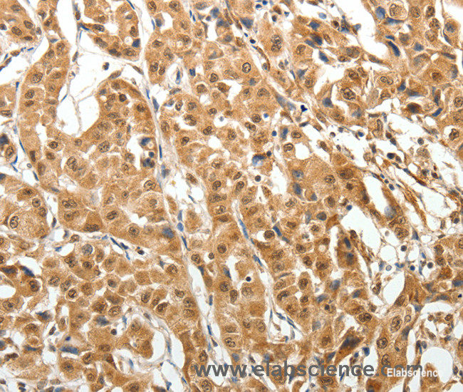 Immunohistochemistry of paraffin-embedded Human lung cancer tissue using MAP1A Polyclonal Antibody at dilution 1:40