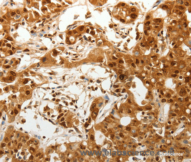 Immunohistochemistry of paraffin-embedded Human ovarian cancer tissue using TENM3 Polyclonal Antibody at dilution 1:50