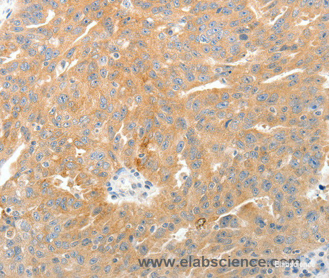 Immunohistochemistry of paraffin-embedded Human ovarian cancer tissue using TEP1 Polyclonal Antibody at dilution 1:50