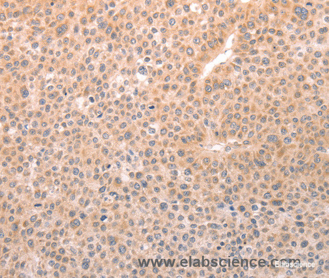 Immunohistochemistry of paraffin-embedded Human liver cancer tissue using TRPC3 Polyclonal Antibody at dilution 1:50