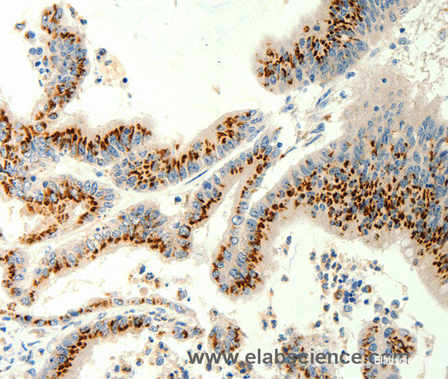 Immunohistochemistry of paraffin-embedded Human colon cancer tissue using TRPC6 Polyclonal Antibody at dilution 1:40