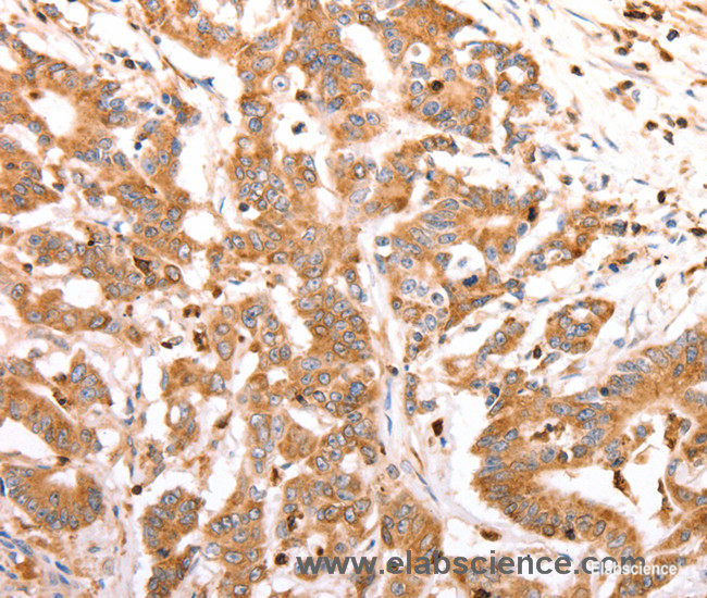 Immunohistochemistry of paraffin-embedded Human colon cancer tissue using CELSR2 Polyclonal Antibody at dilution 1:50
