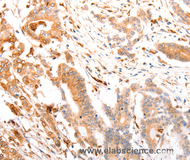Immunohistochemistry of paraffin-embedded Human colon cancer tissue using ABCA4 Polyclonal Antibody at dilution of 1:30
