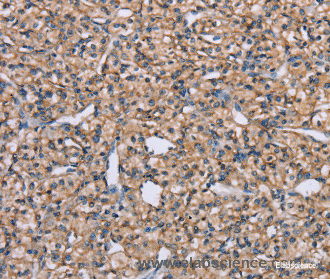 Immunohistochemistry of paraffin-embedded Human prostate cancer tissue using ADAM29 Polyclonal Antibody at dilution 1:40