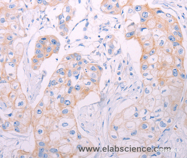 Immunohistochemistry of paraffin-embedded Human breast cancer tissue using ADAMTS14 Polyclonal Antibody at dilution 1:50