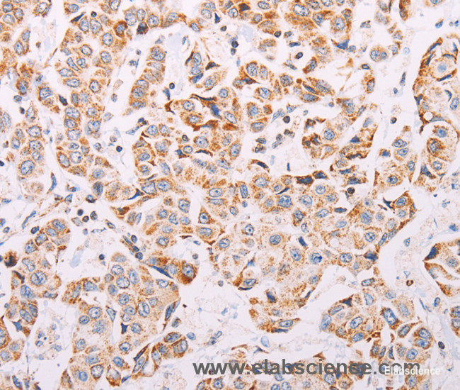 Immunohistochemistry of paraffin-embedded Human breast cancer tissue using ADAMTS16 Polyclonal Antibody at dilution 1:50
