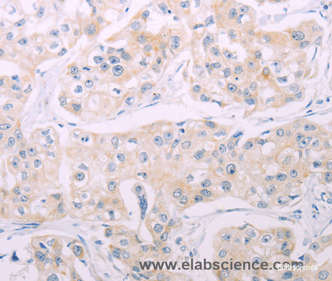 Immunohistochemistry of paraffin-embedded Human breast cancer tissue using ADCY7 Polyclonal Antibody at dilution 1:60