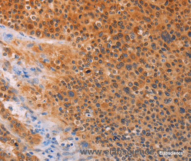 Immunohistochemistry of paraffin-embedded Human liver cancer tissue using ADHFE1 Polyclonal Antibody at dilution 1:30