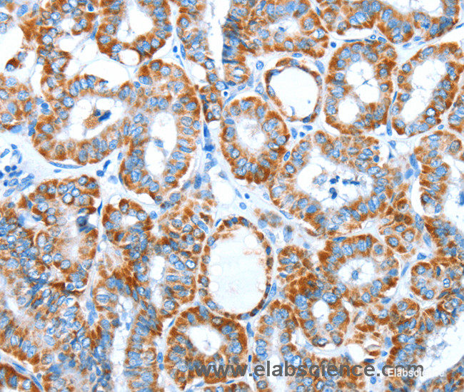 Immunohistochemistry of paraffin-embedded Human thyroid cancer tissue using ALDH5A1 Polyclonal Antibody at dilution 1:60
