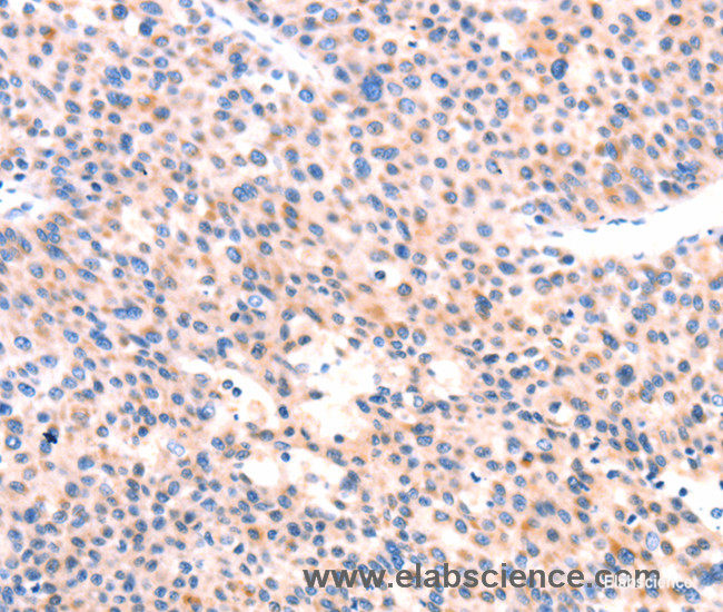 Immunohistochemistry of paraffin-embedded Human liver cancer tissue using APBA2 Polyclonal Antibody at dilution 1:80