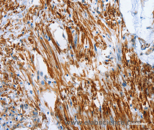Immunohistochemistry of paraffin-embedded Human colon cancer tissue using SHROOM2 Polyclonal Antibody at dilution 1:50