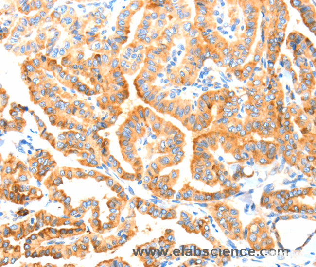 Immunohistochemistry of paraffin-embedded Human thyroid cancer tissue using MANF Polyclonal Antibody at dilution 1:70