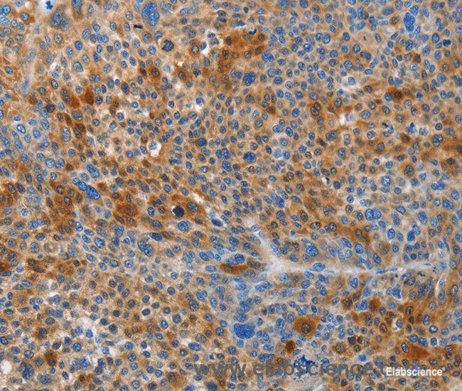 Immunohistochemistry of paraffin-embedded Human liver cancer tissue using HTRA3 Polyclonal Antibody at dilution 1:45