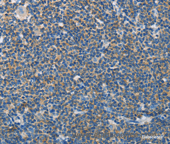 Immunohistochemistry of paraffin-embedded Human lymphoma tissue using NEK5 Polyclonal Antibody at dilution 1:60