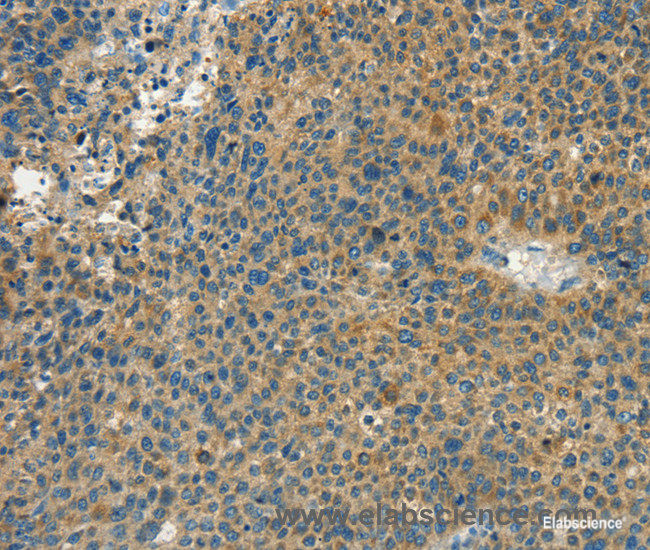 Immunohistochemistry of paraffin-embedded Human liver cancer tissue using CALCA Polyclonal Antibody at dilution 1:60