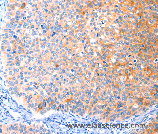 Immunohistochemistry of paraffin-embedded Human cervical cancer tissue using CCDC88A Polyclonal Antibody at dilution 1:50