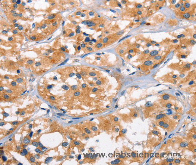 Immunohistochemistry of paraffin-embedded Human thyroid cancer tissue using AHR Polyclonal Antibody at dilution 1:50