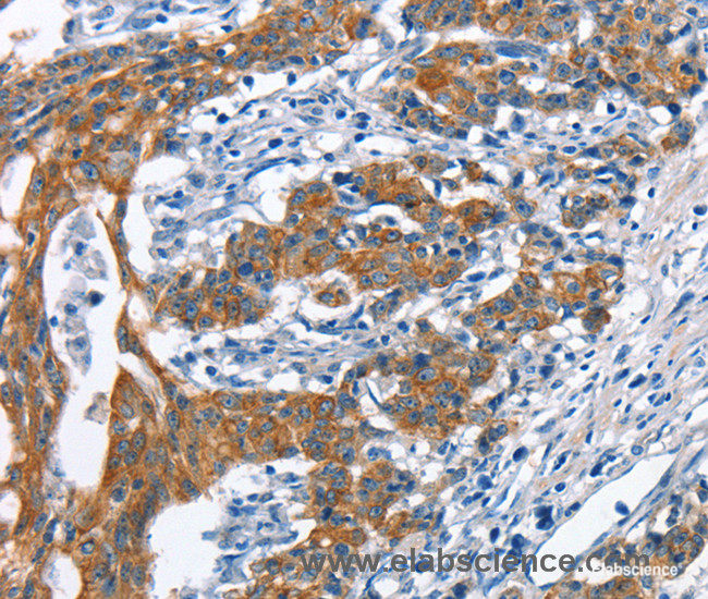 Immunohistochemistry of paraffin-embedded Human gasrtic cancer tissue using MMP2 Polyclonal Antibody at dilution 1:60