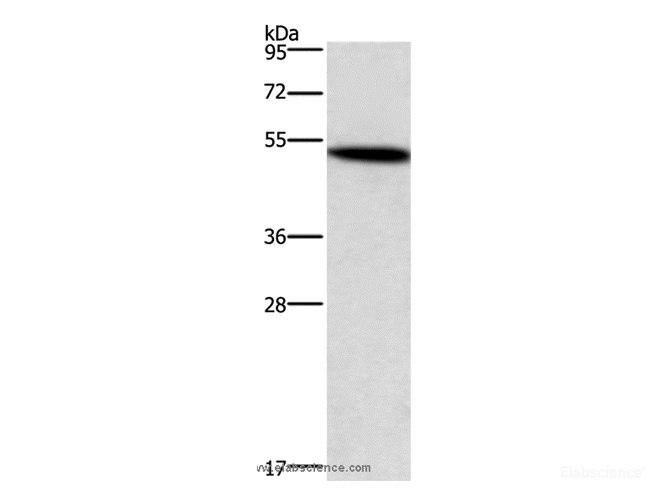 Western Blot analysis of Human kindey cancer tissue using SMAD3 Polyclonal Antibody at dilution of 1:400