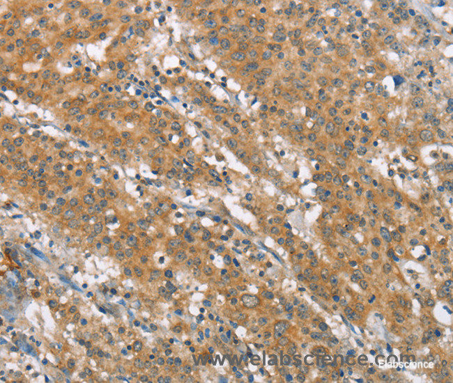 Immunohistochemistry of paraffin-embedded Human gasrtic cancer tissue using NLRP7 Polyclonal Antibody at dilution 1:40