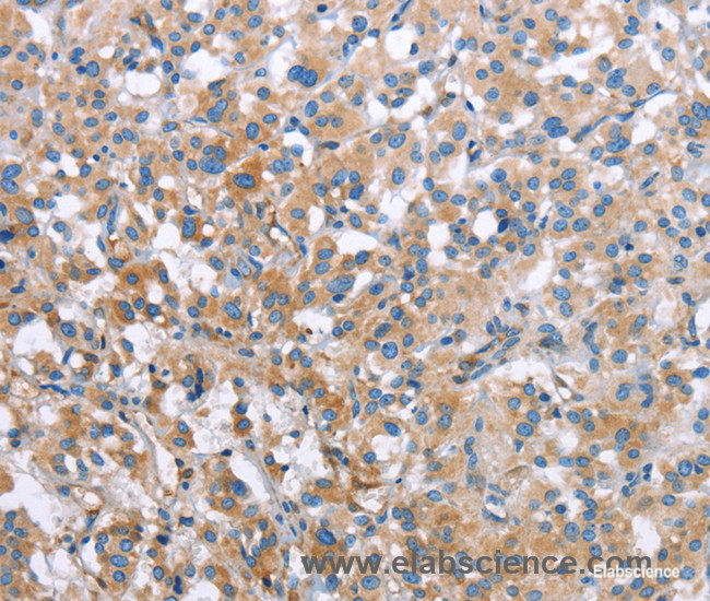 Immunohistochemistry of paraffin-embedded Human thyroid cancer tissue using MCL1 Polyclonal Antibody at dilution 1:60