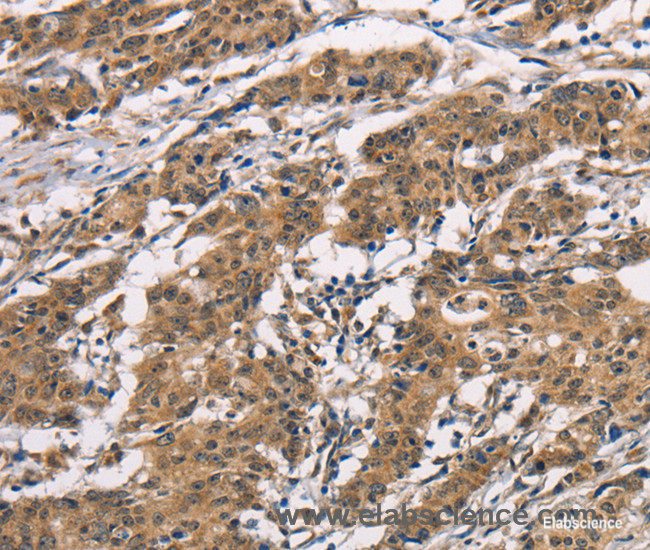 Immunohistochemistry of paraffin-embedded Human gasrtic cancer tissue using ADGRB1 Polyclonal Antibody at dilution 1:40