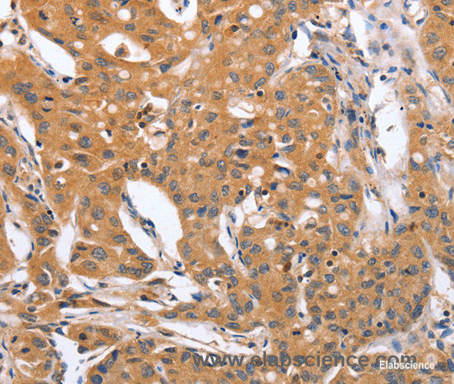 Immunohistochemistry of paraffin-embedded Human lung cancer tissue using BLNK Polyclonal Antibody at dilution 1:50