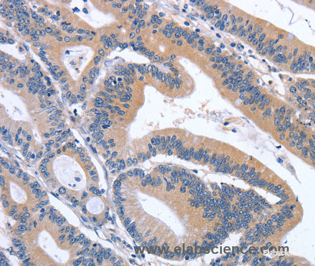 Immunohistochemistry of paraffin-embedded Human colon cancer tissue using GDF11 Polyclonal Antibody at dilution 1:30