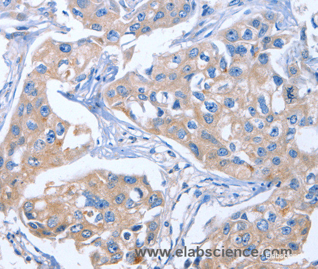 Immunohistochemistry of paraffin-embedded Human breast cancer tissue using IBSP Polyclonal Antibody at dilution of 1:50