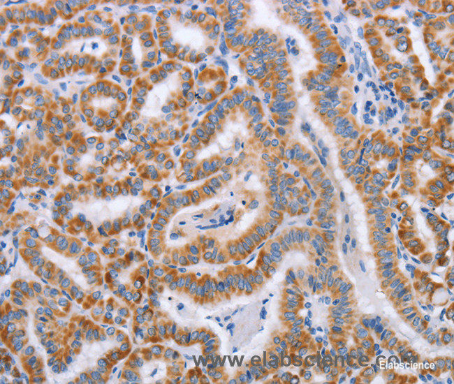 Immunohistochemistry of paraffin-embedded Human thyroid cancer tissue using BST1 Polyclonal Antibody at dilution 1:50