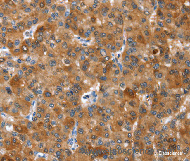 Immunohistochemistry of paraffin-embedded Human liver cancer tissue using NOD2 Polyclonal Antibody at dilution 1:40